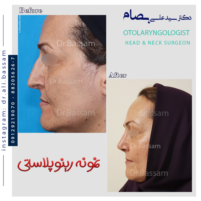 جراحی بینی در سنین بالا