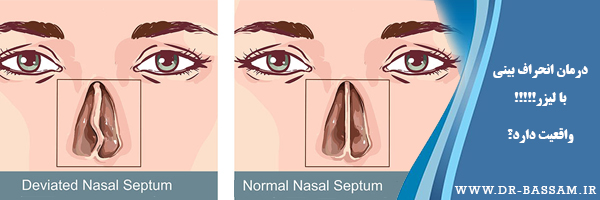 درمان انحراف بینی با لیزر