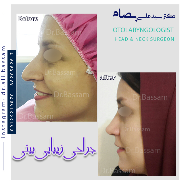 عکس از نیم رخ قبل و بعد عمل بینی