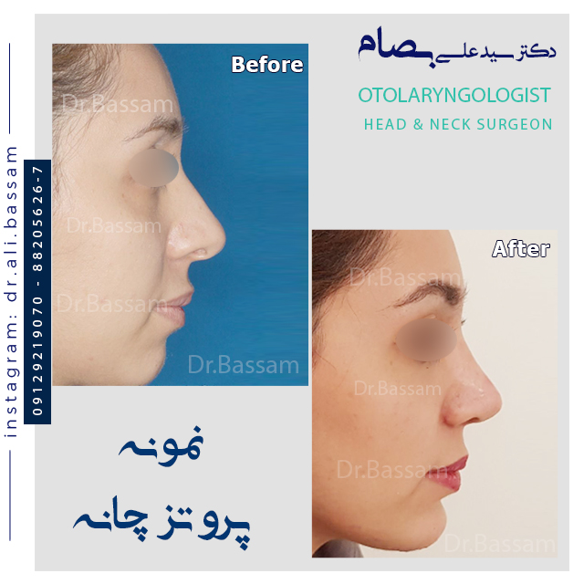 عکس قبل و بعد پروتز چانه