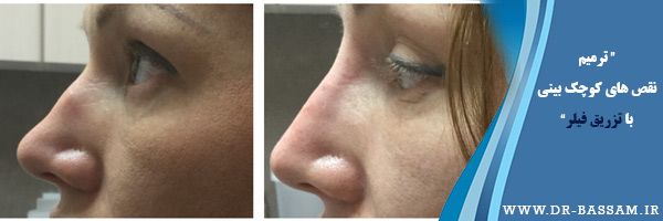 تزریق ژل به قوز بینی
