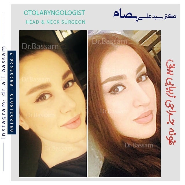 جراحی بینی با لیزر واقعیت دارد؟