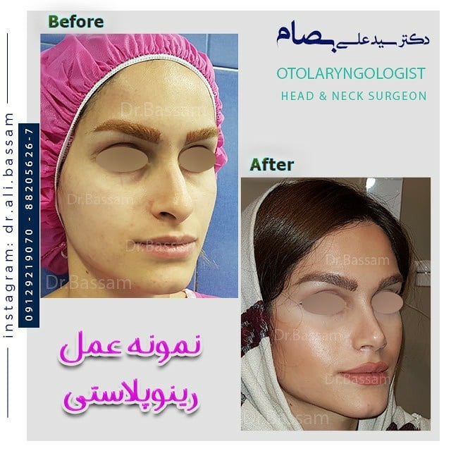 جراحی بینی به روش باز