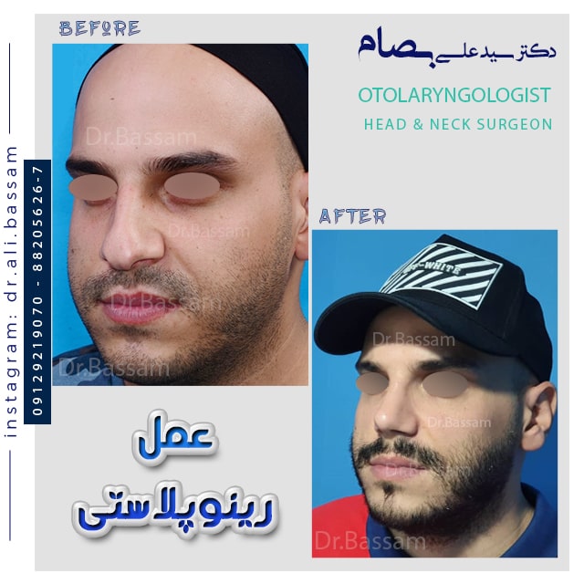 جراحی طبیعی بینی مردانه