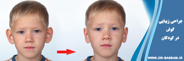 جراحی زیبایی گوش در کودکان