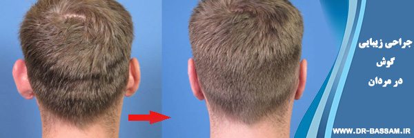 جراحی زیبایی گوش در مردان