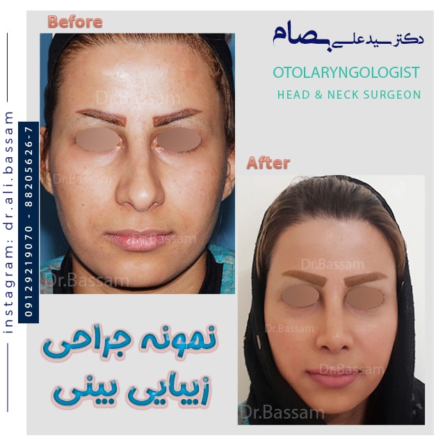 عمل بینی استخوانی و کج