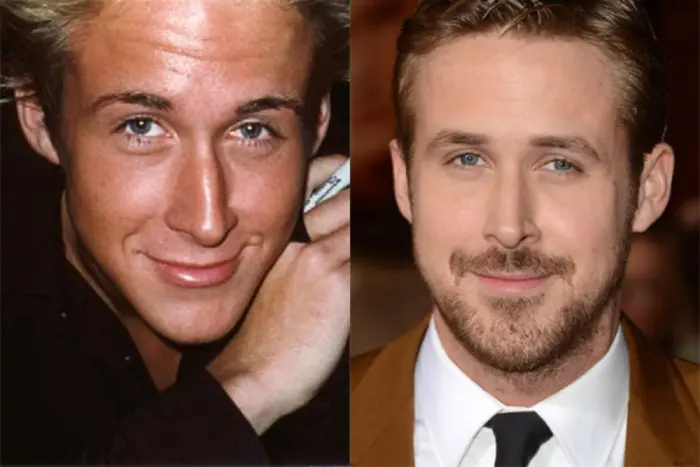 تعییر چهره بعد از جراحی بینی