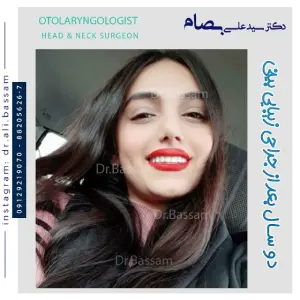 تغییر چهره بعد از جراحی بینی چقدر است