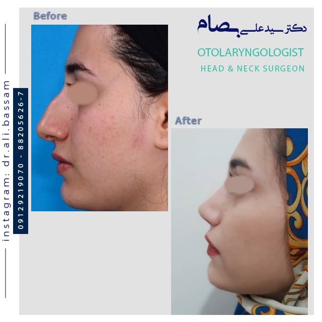 عمل بینی غضروفی