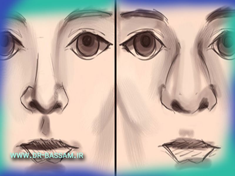 عمل بینی پهن