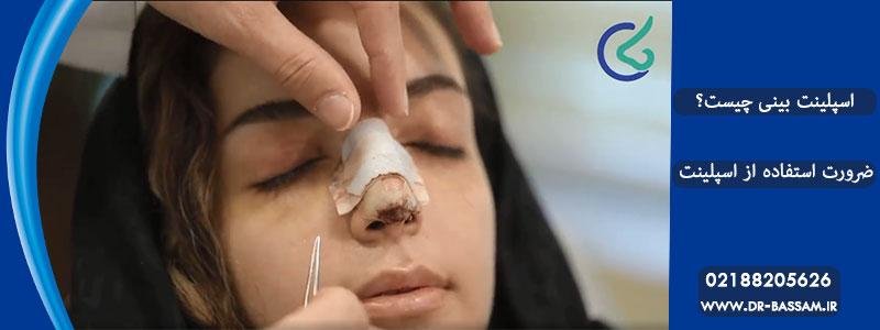 استفاده از اسپلینت بعد از جراحی بینی