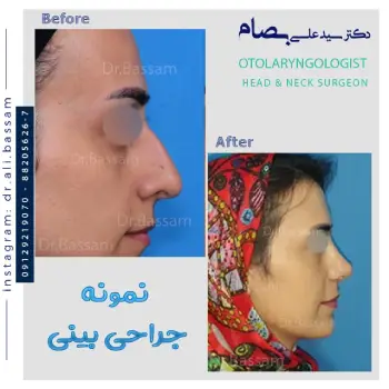 اصلاح افتادگی نوک بینی