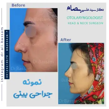 جراحی افتادگی نوک بینی