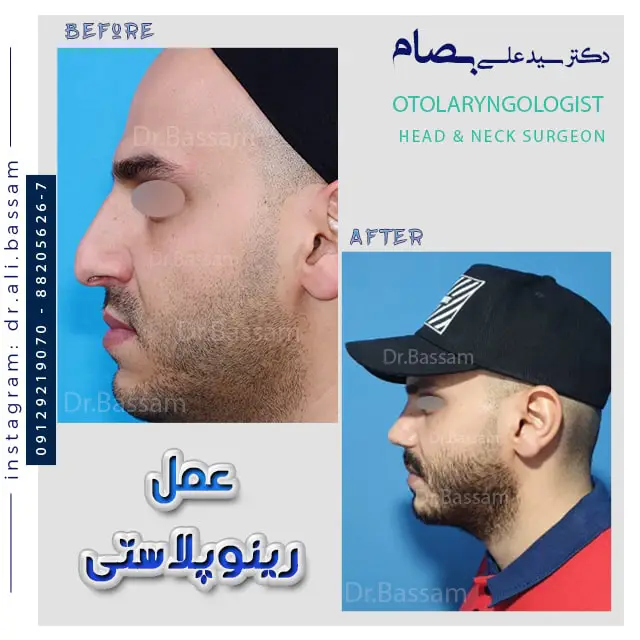 عمل افتادگی نوک بینی