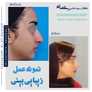 عکس عمل بینی استخوانی طبیعی