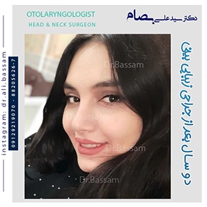 جراحی بینی استخوانی فانتزی