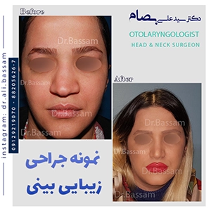 جراحی بینی استخوانی نیمه فانتزی
