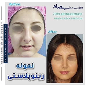 عمل بینی استخوانی نیمه فانتزی