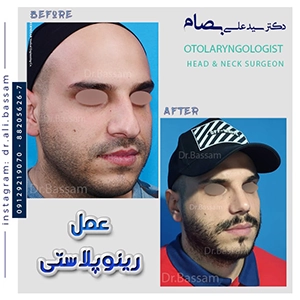 جراحی بینی استخوانی طبیعی