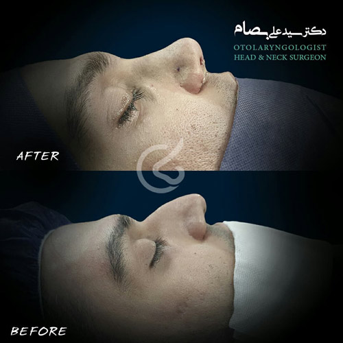 عمل بینی در سن کم