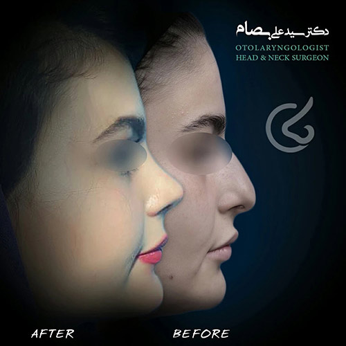 بهترین سن عمل بینی