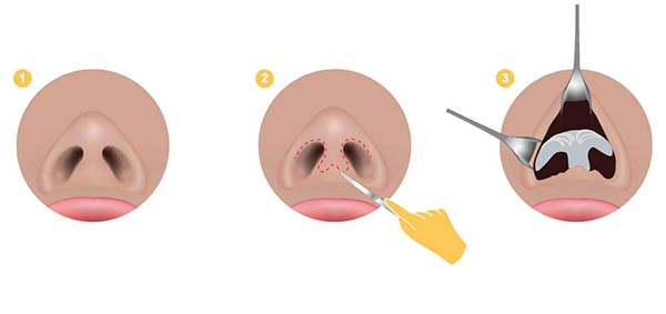 عمل بینی به روش باز