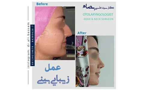 نحوه جراحی قوز بینی