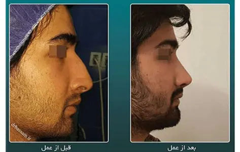 نحوه جراحی قوز بینی