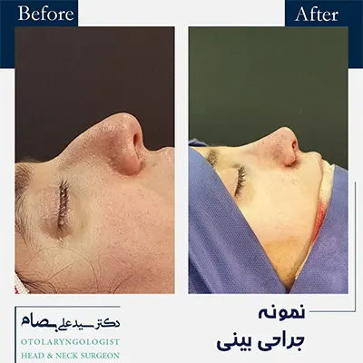 نمونه-جراحی-بینی-استخوانی