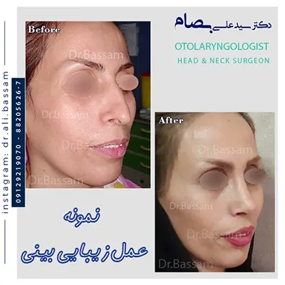 نمونه-عمل-زیبایی-بینی