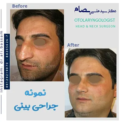نمونه-کار-جراحی-بینی-مردانه