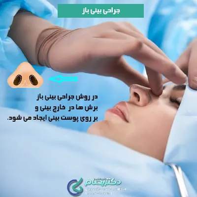 جراحی-بینی-نیمه-فانتزی-به-روش-باز