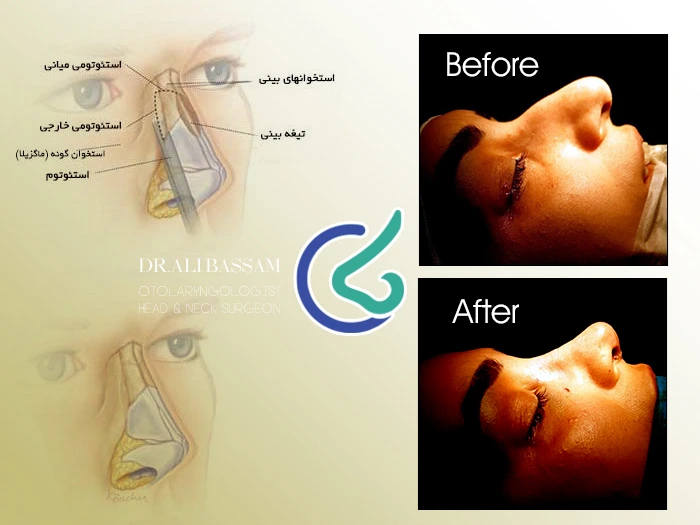 عکس قبل و بعد سوهان کشیدن بینی