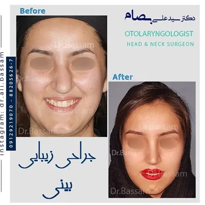 انحراف بینی دکتر بصام