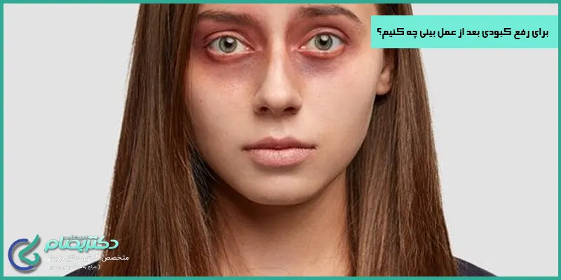 برای-رفع-کبودی-بعد-از-عمل-بینی-چه-کنیم؟