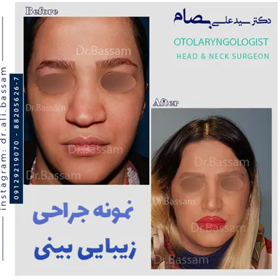 عمل انحراف بینی دکتر بصام