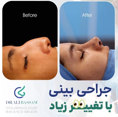 جراحی بینی قوز دار