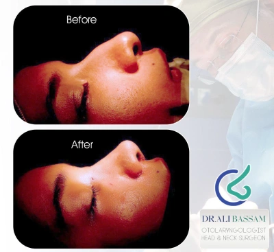 جراحی قوز بینی