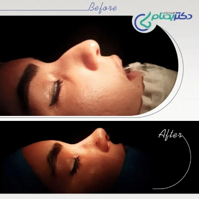 عمل بینی قوز دار