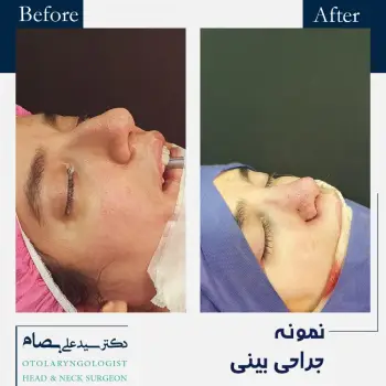 عمل بینی بدون بخیه