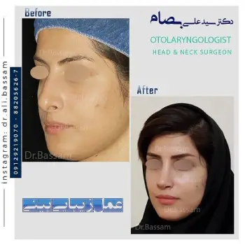 عمل بینی بسته