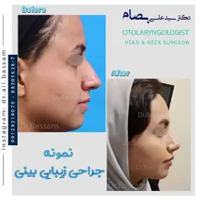 قیمت عمل بینی دخترانه