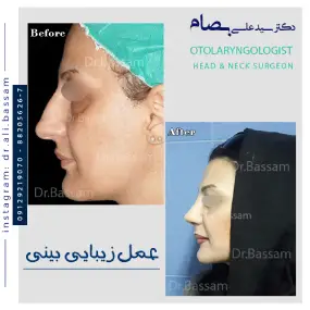 قیمت عمل بینی زنانه