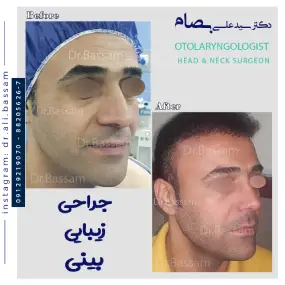 قیمت عمل بینی مردانه