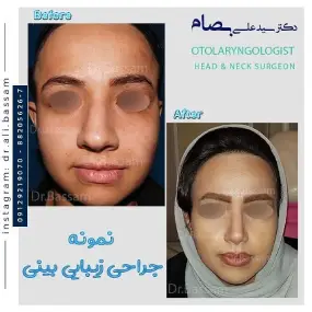 قیمت عمل بینی گوشتی