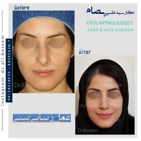 قیمت عمل بینی