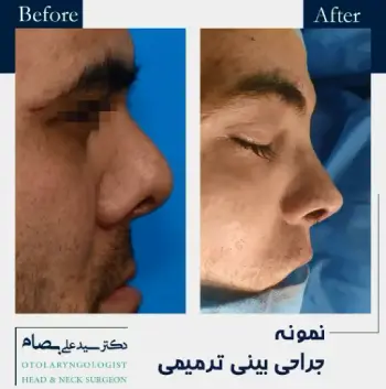 هزینه عمل بینی آقایان