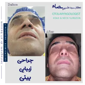 هزینه عمل بینی آقایان