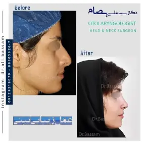 هزینه عمل بینی استخوانی